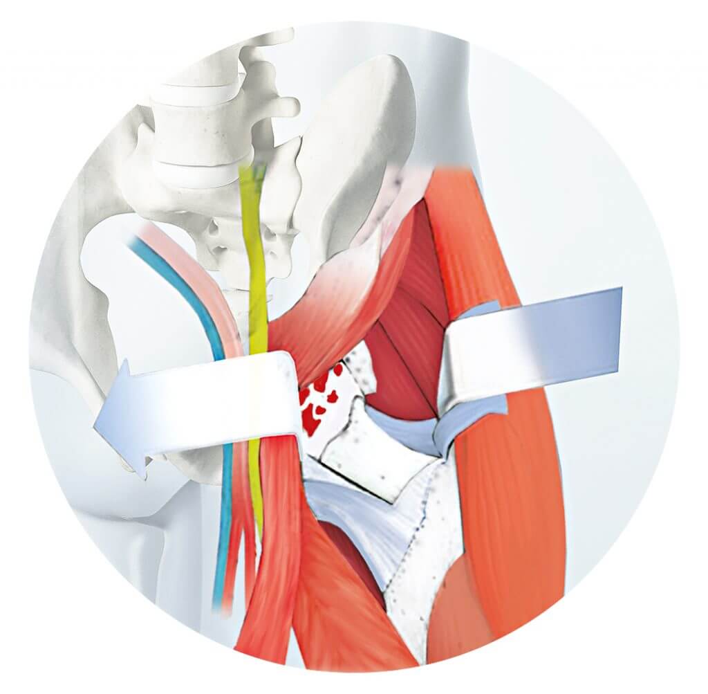 Hüftprothese schonend mit AMISTechnik Orthopress Das neue Onlineportal rund um Ihre Gesundheit