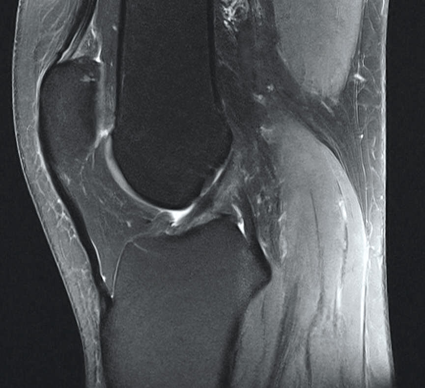 Kreuzband Heilung Auch Ohne Op Orthopress Das Neue Onlineportal Rund Um Ihre Gesundheit