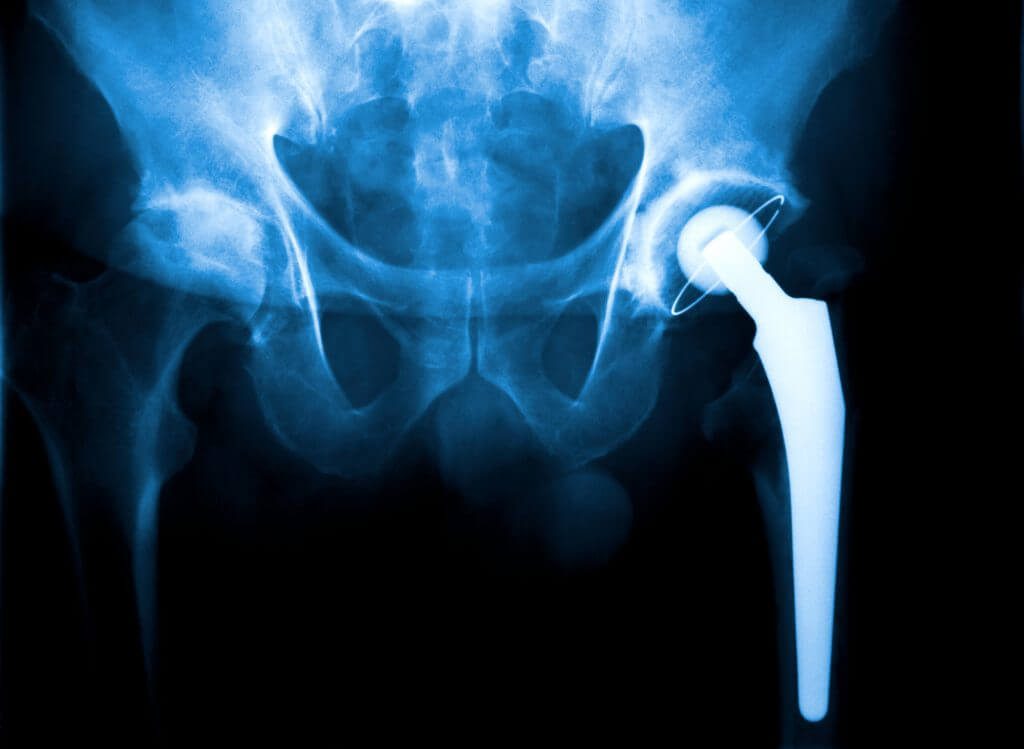 Hüftprothese – Die wichtigsten OP-Methoden auf einen Blick
