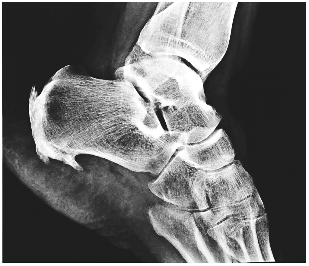 Plantarfasziitis - Orthopress | Das neue Onlineportal rund um Ihre ...