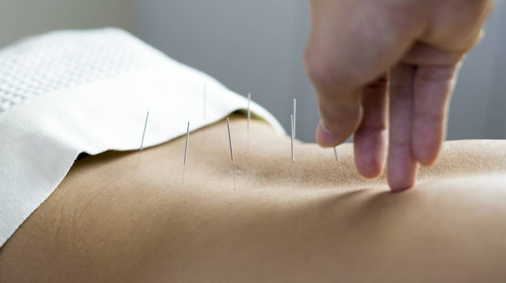 Frau bekommt Akupunktur