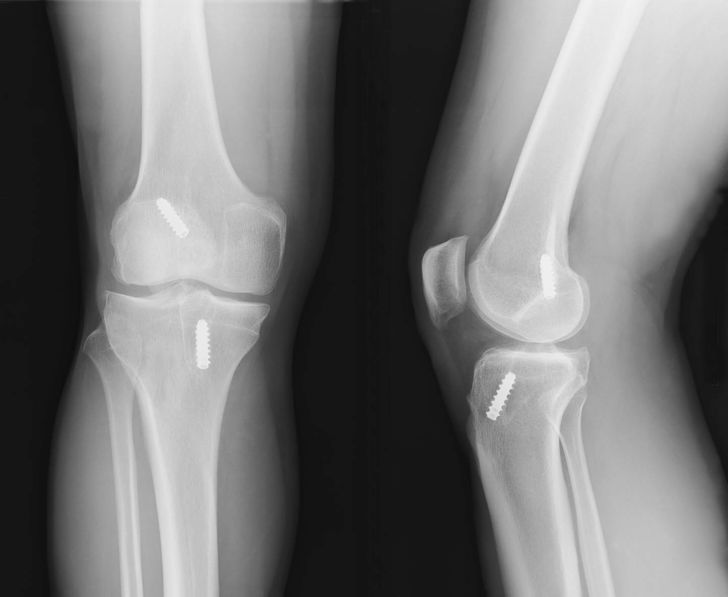 Операция колено пкс. Пластика передней крестообразной связки рентген. Пластика ПКС коленного сустава рентген. Пластика передней крестообразной связки коленного сустава рентген. Разрыв связок коленного сустава рентген.