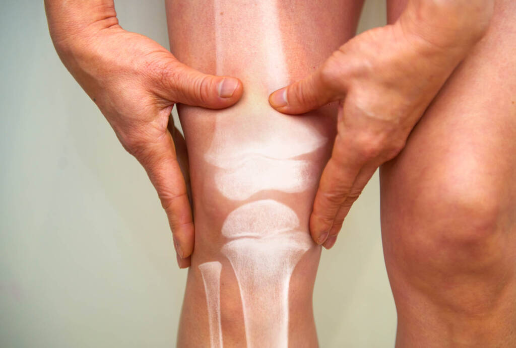 Kniearthrose: Nicht vorschnell zum Gelenkersatz greifen