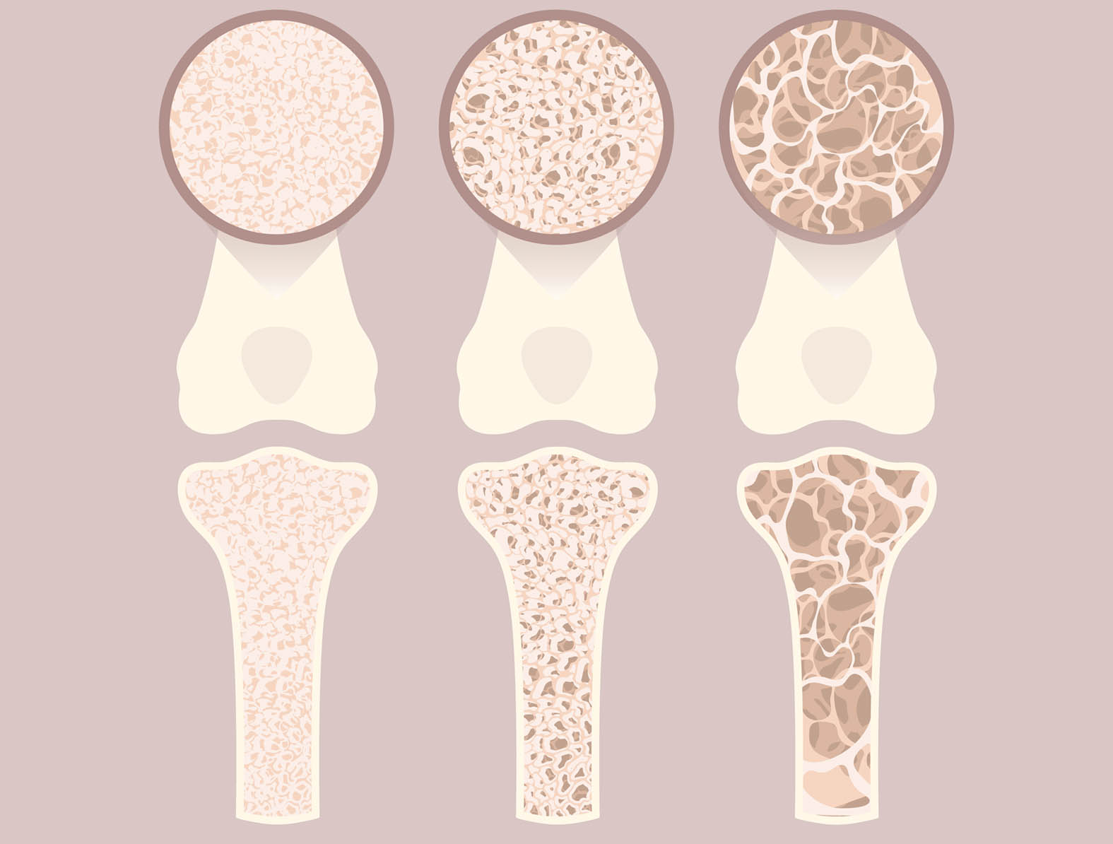 Osteoporose: Immer sicher auf den Beinen