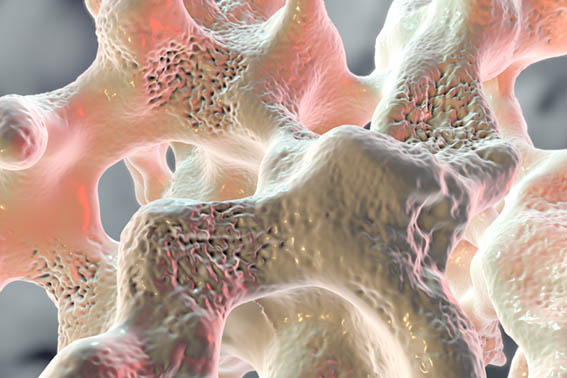 Die Diagnose der Osteoporose