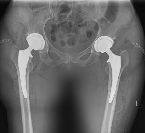 Röntgen einer Patientin mit beidseitiger Arthrose nach der OP