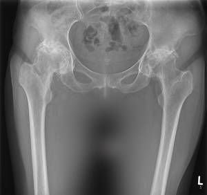 Röntgen einer Patientin mit beidseitiger Arthrose vor der OP
