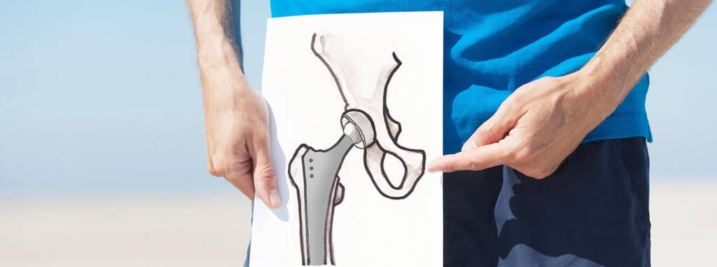 Hüft-Endoprothetik | Alles zu Gelenkersatz und Kurzschaftprothesen