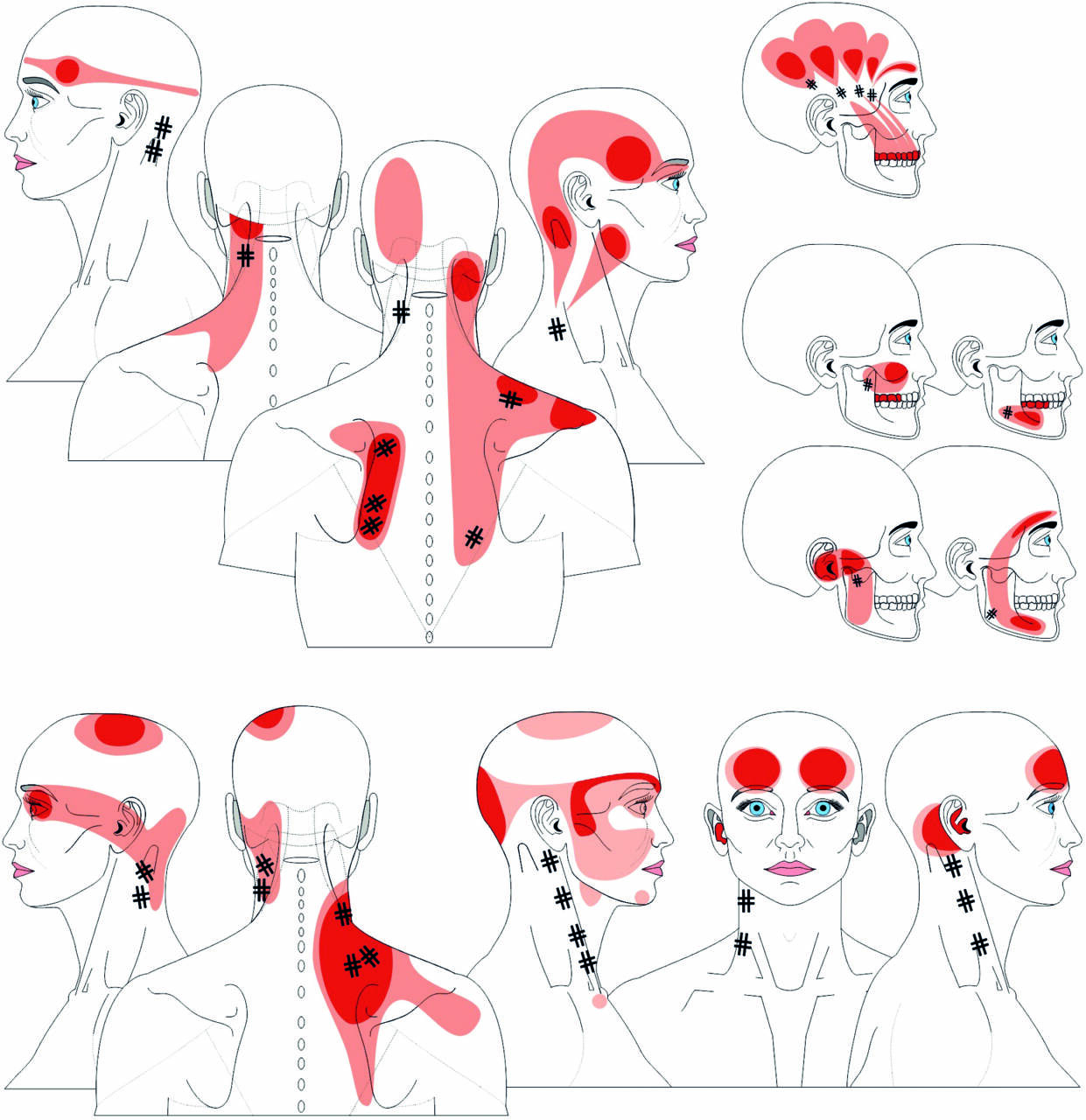 bauermeister cummings referred pain head neck