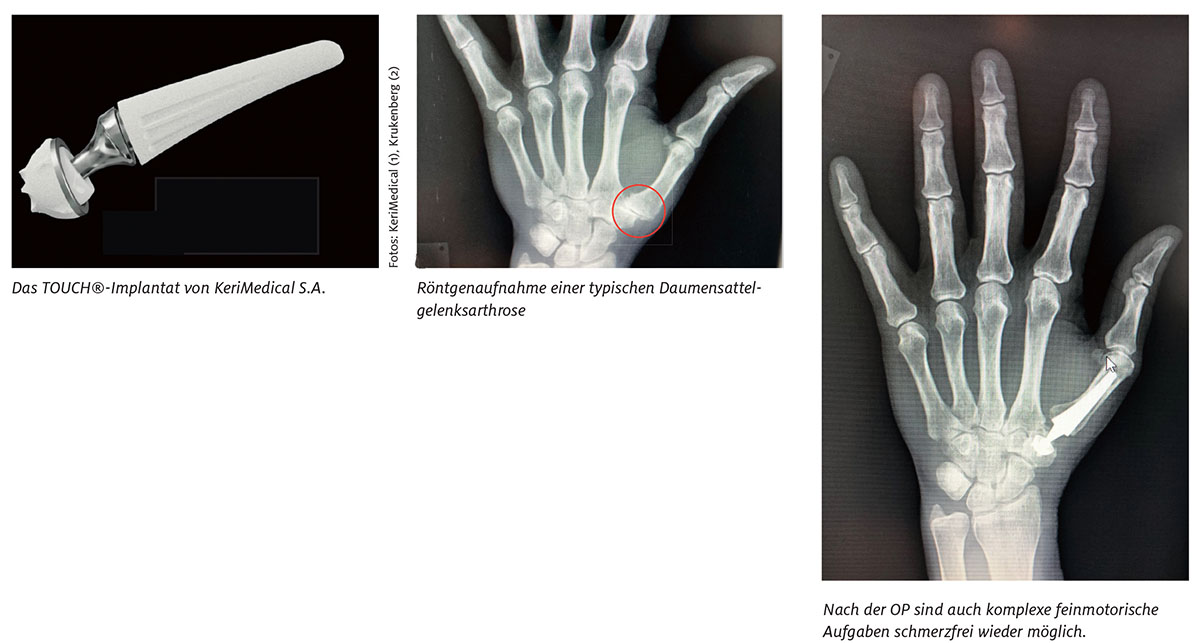 krukenberg roentgen web