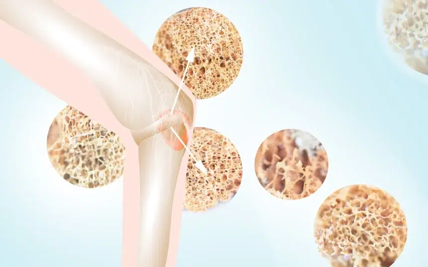 osteoporose aumf red rz