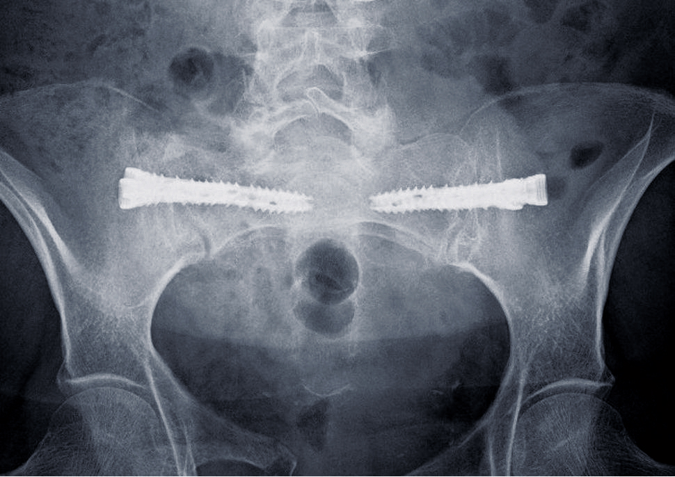 iFuse 3D™ – Röntgenaufnahme degenerativer Fall