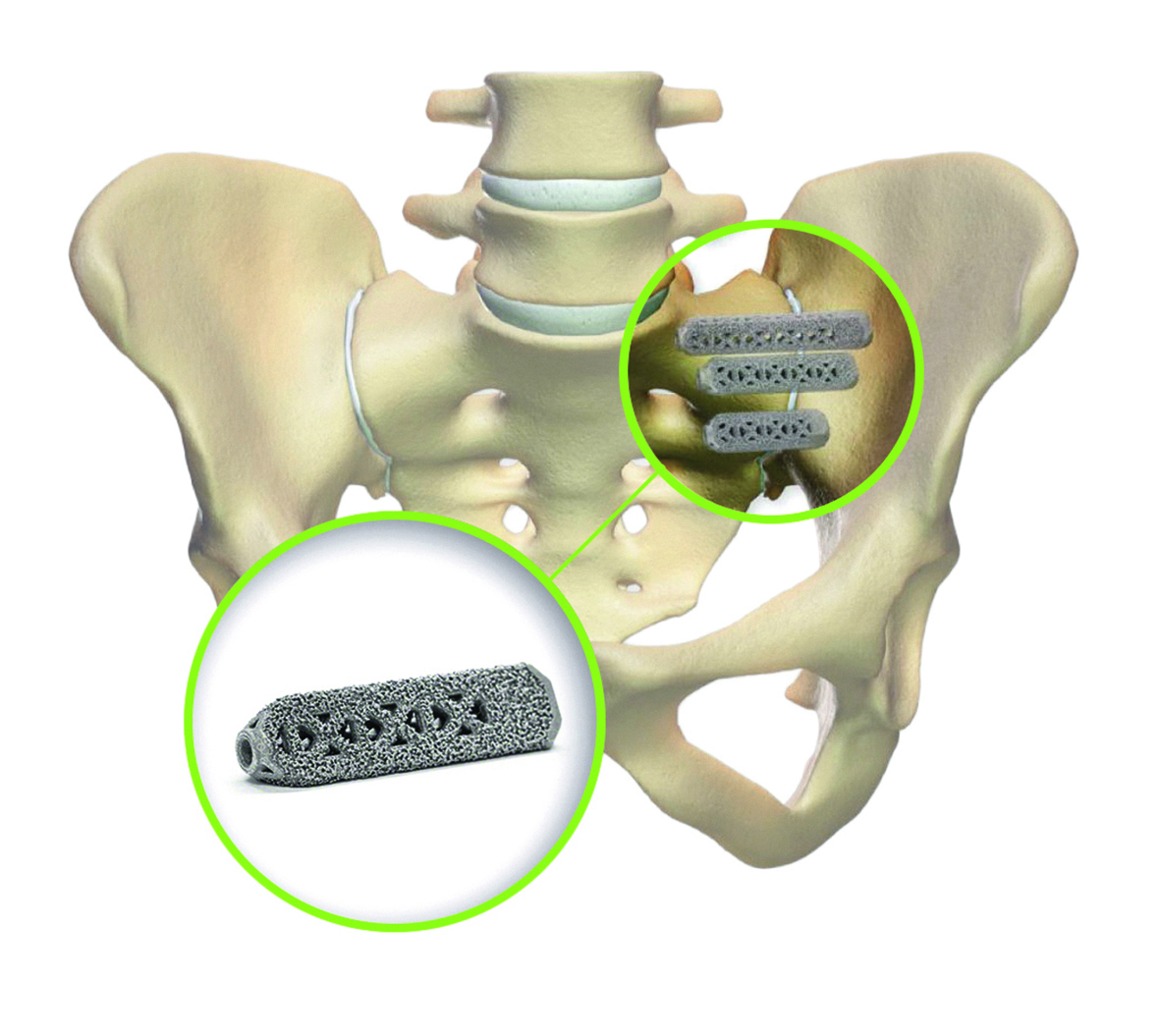 iFuse-Implantat – Darstellung im Becken