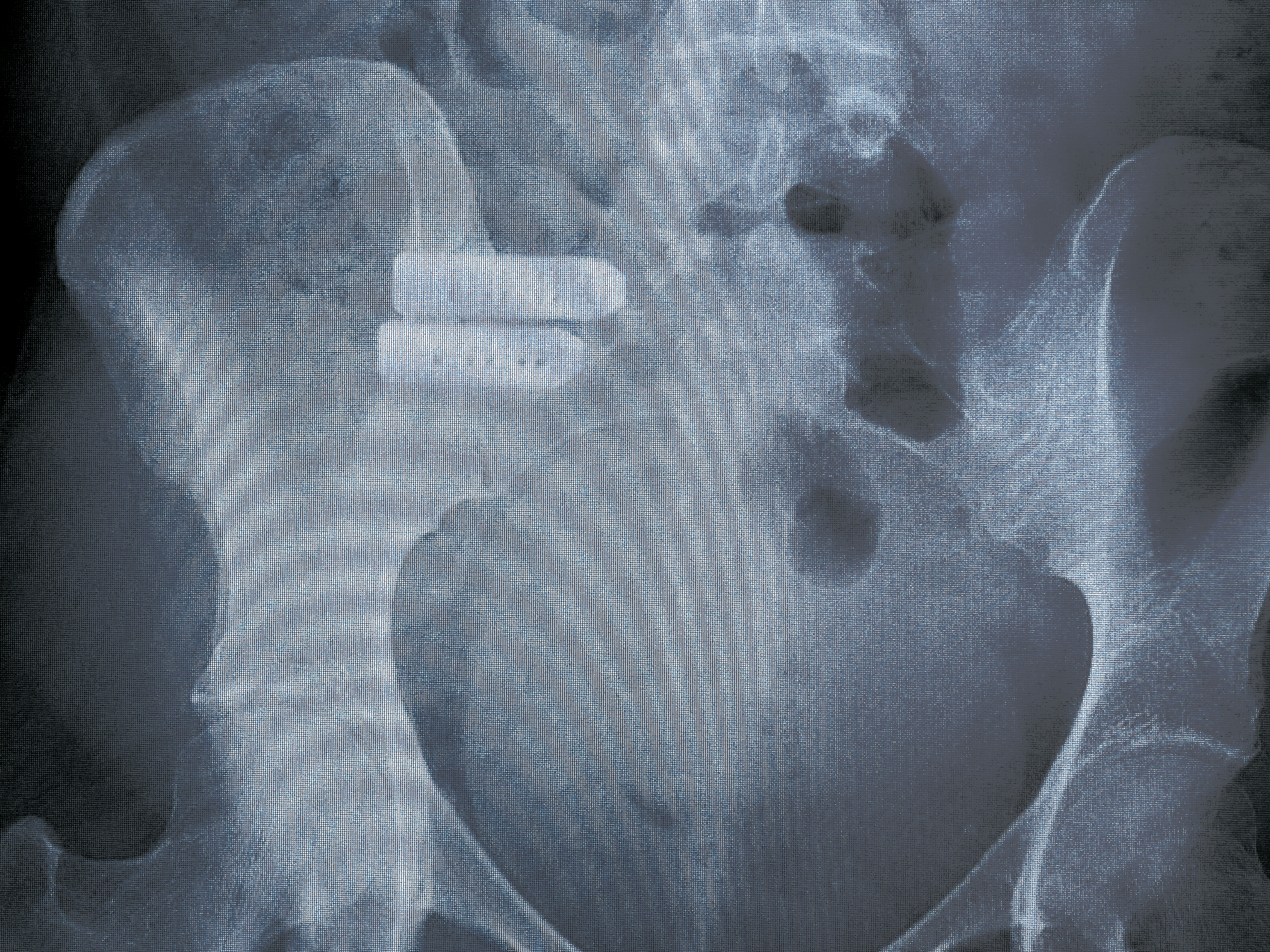 iFuse Torq™ – Röntgenaufnahme Fragilitätsfrakturen