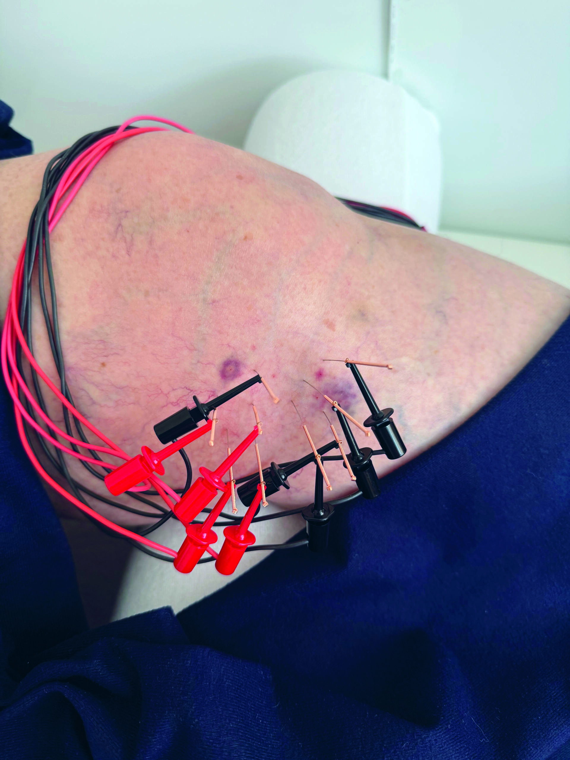 Axomera-Behandlung am Knie